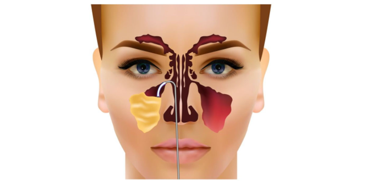 Penanganan Sinusitis Tak Harus Dengan Operasi, Ini Penjelasan Dr ...